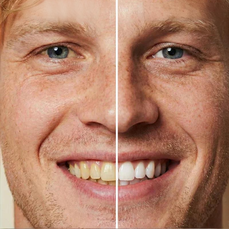 🏆 Nieuw in 2026: 🧴Directe tandenbleekverf